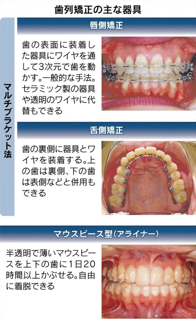 矯正 歯並び