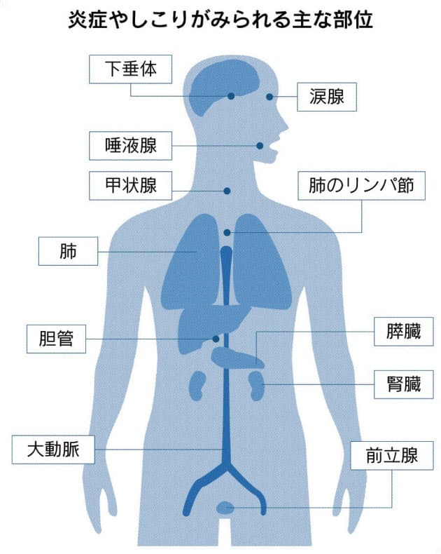 一つの病で各部に炎症 しこり Igg4関連疾患を知る Nikkei Style 一つの病で各部に炎症 しこり Igg4関連疾患を知る Nikkei Style