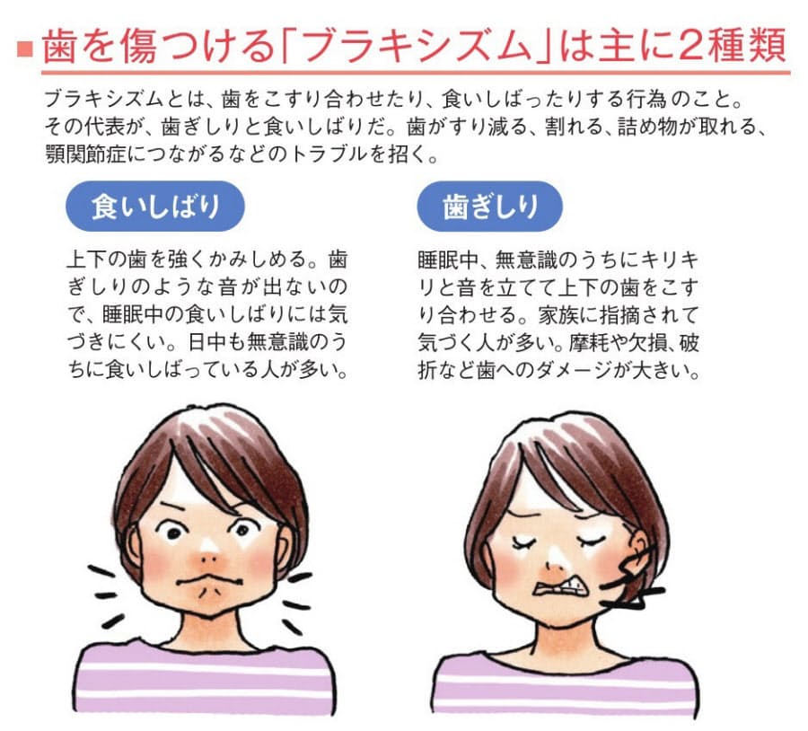 歯ぎしりで歯を失う人が増加 神経抜いていたら要注意 Nikkei Style