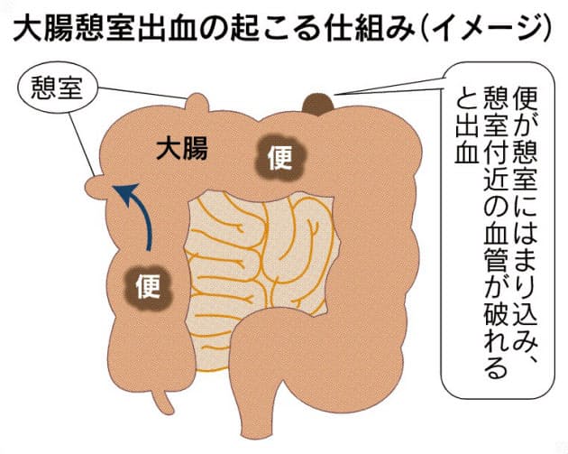 炎 アルコール 憩室 大腸 食事