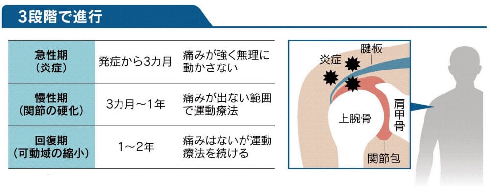 気温低下は要注意 いきなり痛む五十肩を運動で防ぐ|ヘルスUP ... Progression stage of forty shoulders and frozen shoulders