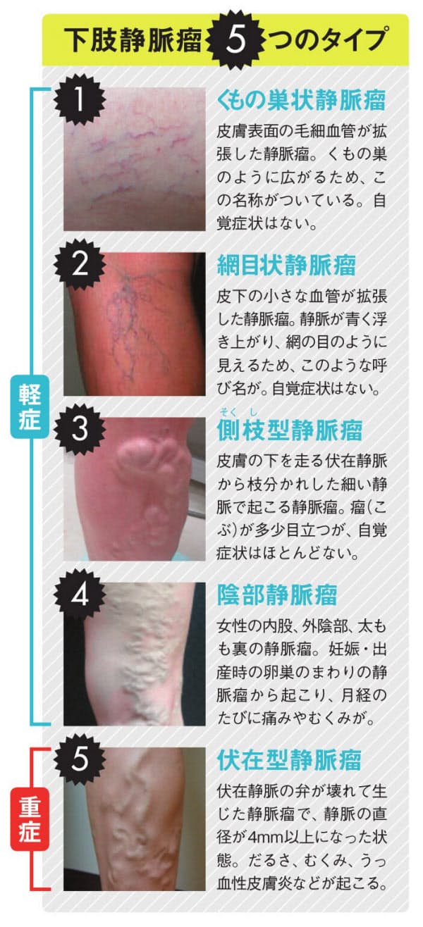 出産した人の半数で下肢静脈瘤 ふくらはぎを使って歩こう 実は多い脚の静脈の病防ぐ Nikkei Style 出産した人の半数で下肢静脈瘤 ふくらはぎを使って歩こう 実は多い脚の静脈の病防ぐ Nikkei Style
