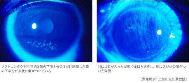 コンタクトレンズやゴミで 角膜に傷 コンタクトやitによるドライアイ 点眼薬で角 Nikkei Style コンタクトレンズやゴミで 角膜に傷 コンタクトやitによるドライアイ 点眼薬で角 Nikkei Style