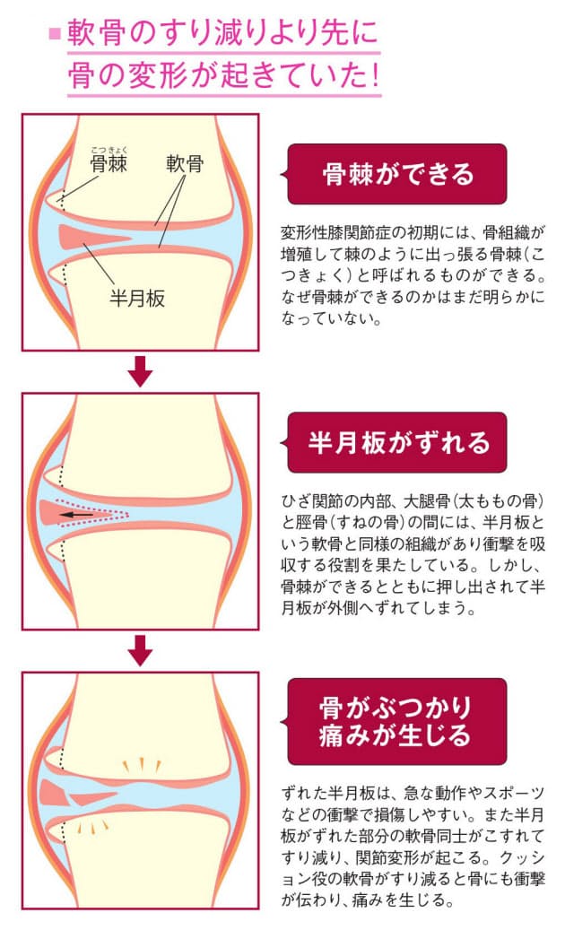 膝の痛みは関節変形のサイン 4つの兆候あれば受診 Nikkei Style