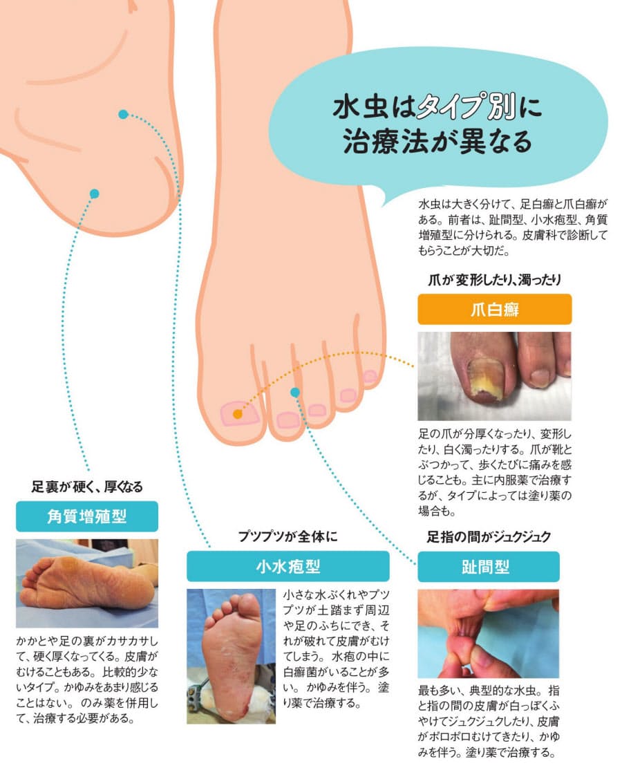 自己判断せず 医療機関を受診する 水虫 自己判断で放置は禁物 糖尿病の人は要注意 Nikkei Style