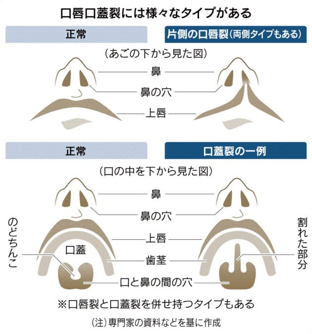 子の口唇口蓋裂 悩まないで 手術で外見も問題なく Nikkei Style