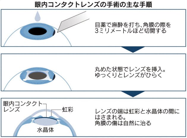 費用 眼 内 コンタクト レンズ