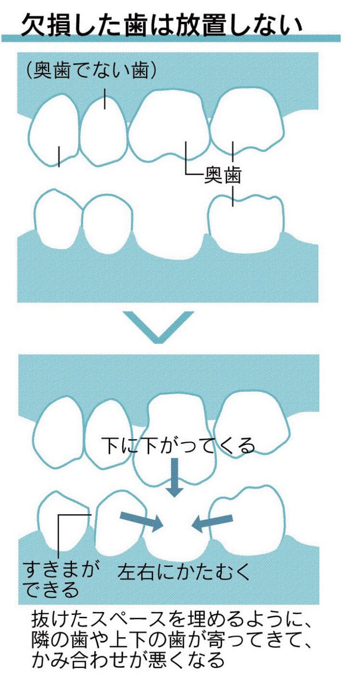 奥歯のダメージ放置しない 頭痛 肩こりの要因に Nikkei Style 奥歯のダメージ放置しない 頭痛 肩こりの要因に Nikkei Style