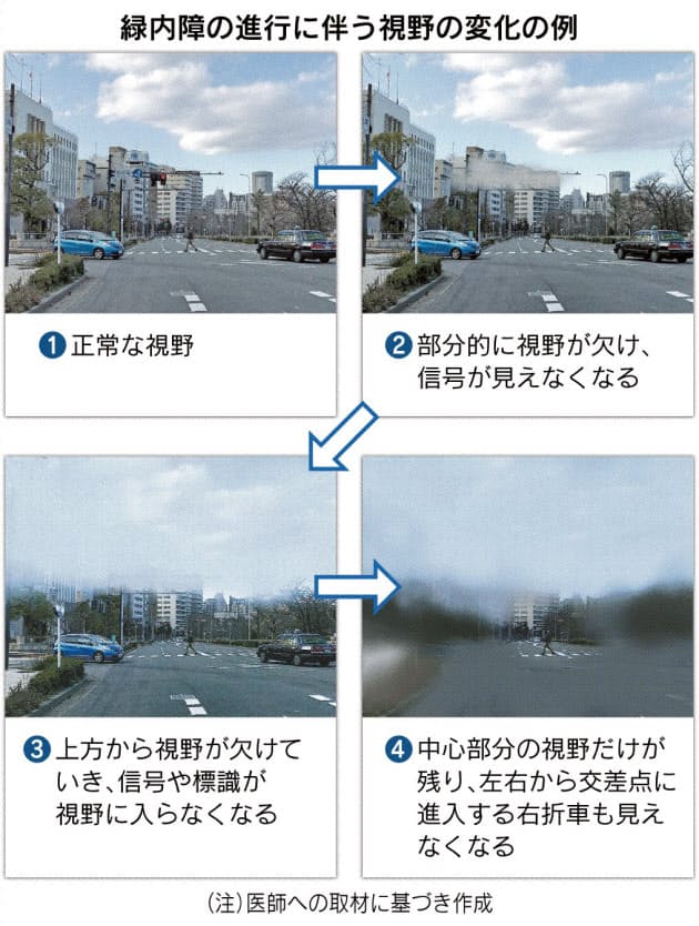 緑内障 70歳以上の1割 自覚しにくく自動車事故の危険 Nikkei Style 緑内障 70歳以上の1割 自覚しにくく自動車事故の危険 Nikkei Style