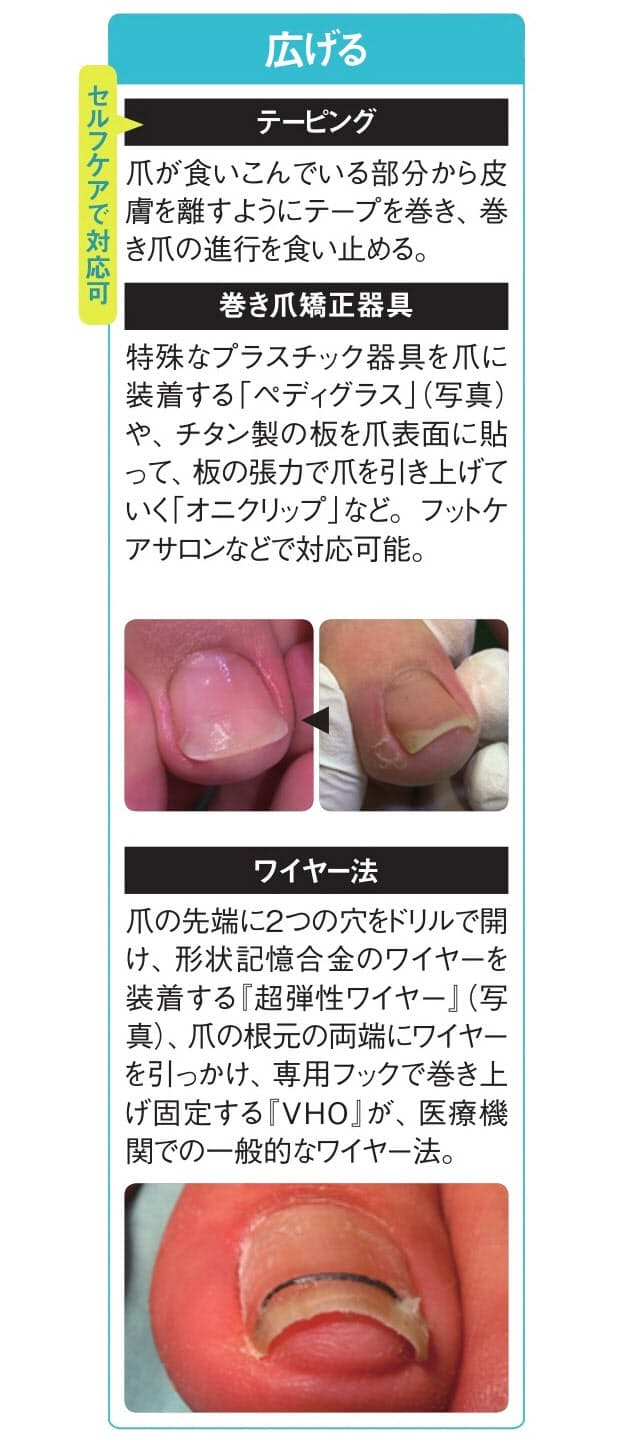 重症度によって治療法は異なる 足の巻き爪は歩いて防ぐ 親指で地面を踏みしめよう Nikkei Style