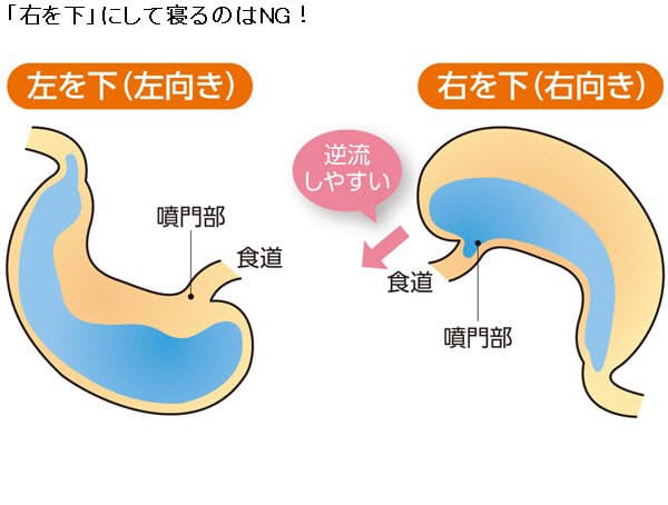 答えと解説 肺炎を招く 誤嚥 右と左 食後してはいけないこと Nikkei Style