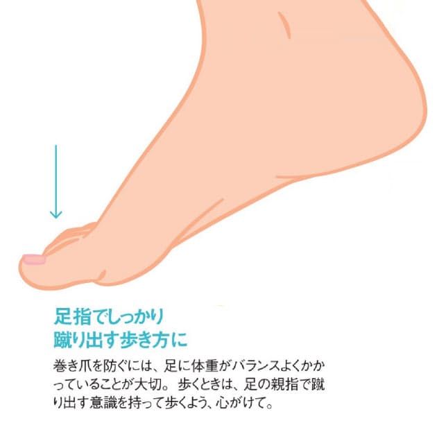 巻き爪 食い込む爪 歩き方や爪の切り方変えてみよう Nikkei Style