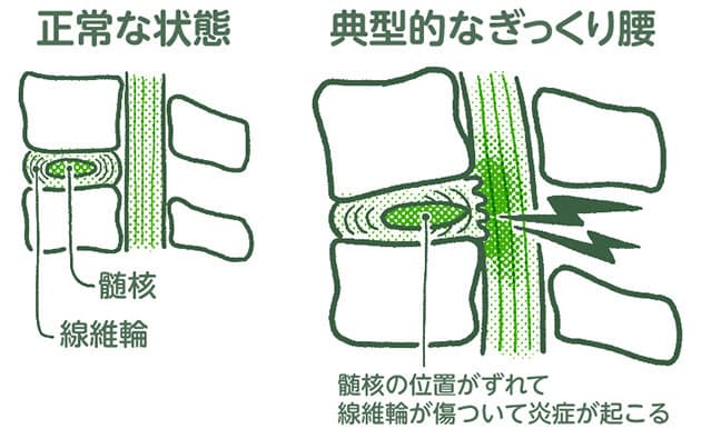 原因 ぎっくり腰