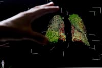 新型コロナウイルス感染症で損傷した肺の3次元CT画像。2020年5月22日にモスクワの国立病院で撮影されたもの(PHOTOGRAPH BY SEFA KARACAN, ANADOLU AGENCY VIA GETTY IMAGES) 新型コロナウイルス感染症で損傷した肺の3次元CT画像。2020年5月22日にモスクワの国立病院で撮影されたもの(PHOTOGRAPH BY SEFA KARACAN, ANADOLU AGENCY VIA GETTY IMAGES)