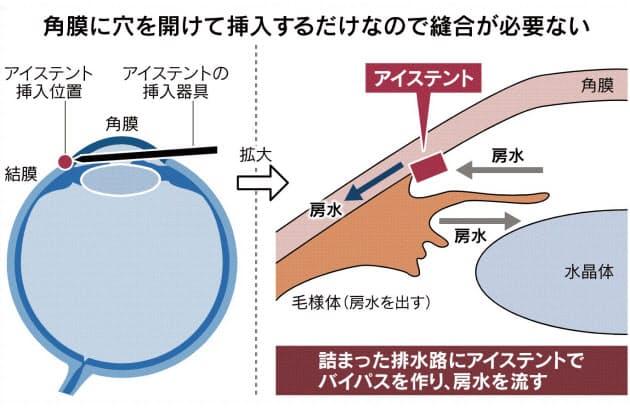 緑内障 早期発見なら10分で手術 目に1ミリの管入れ ヘルスｕｐ Nikkei Style