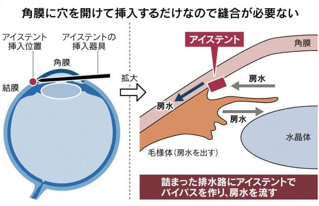 緑内障 早期発見なら10分で手術 目に1ミリの管入れ ヘルスup Nikkei Style