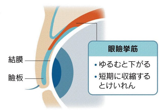 まぶたは心と体の異変の鏡 脳や内臓疾患のサインかも Nikkei Style まぶたは心と体の異変の鏡 脳や内臓疾患のサインかも Nikkei Style