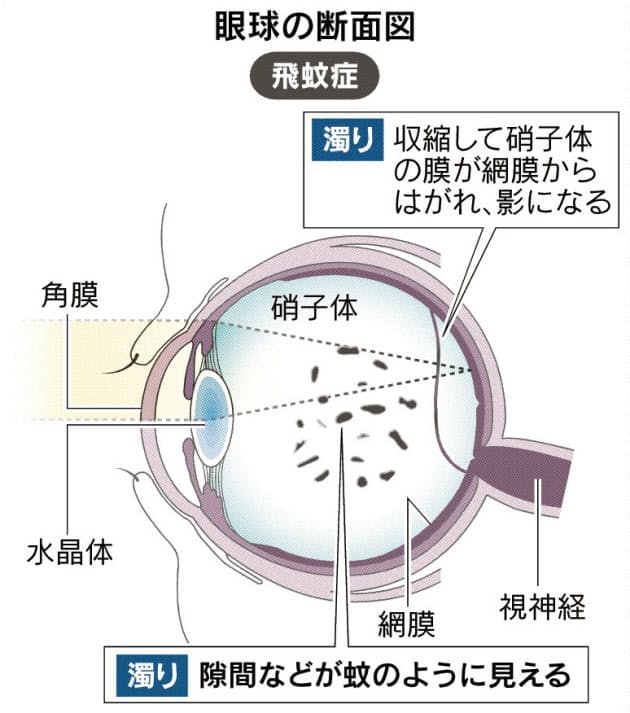 視界に浮遊物 飛蚊症 思わぬ病気や失明の恐れも Nikkei Style 視界に浮遊物 飛蚊症 思わぬ病気や失明の恐れも Nikkei Style