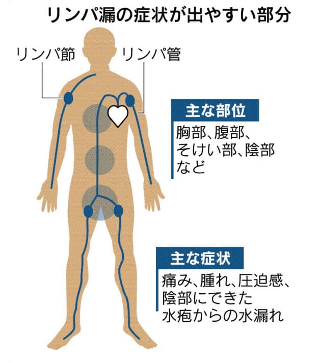 手術痕から リンパ漏 カテーテルで負荷軽く完治も Nikkei Style