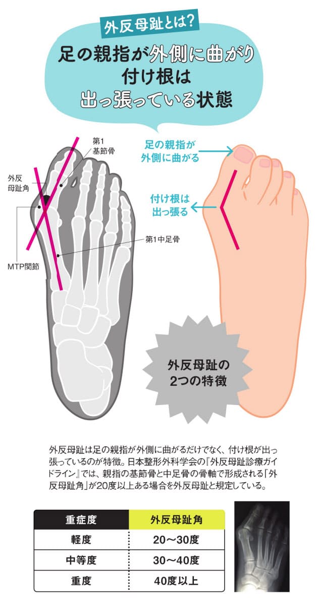 外反母趾 親指だけでない症状 体のバランスにも響く Nikkei Style 外反母趾 親指だけでない症状 体のバランスにも響く Nikkei Style