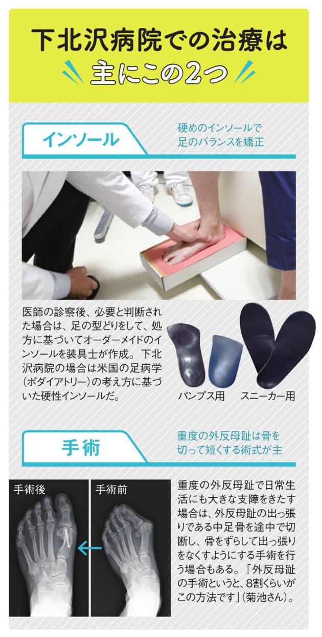 まずはインソールで改善を図る 外反母趾を防ぐには 足指ストレッチでやわらかさ保つ Nikkei Style