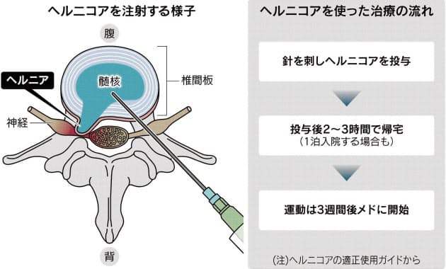 腰のヘルニア 広がる注射治療 全身麻酔不要で日帰り可能 副作用には注意も Nikkei Style Goo ニュース 腰のヘルニア 広がる注射治療 全身麻酔不要で日帰り可能 副作用には注意も Nikkei Style Goo ニュース