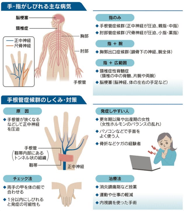 手 指のしびれは早めに受診 放置長いと回復しづらく Nikkei Style