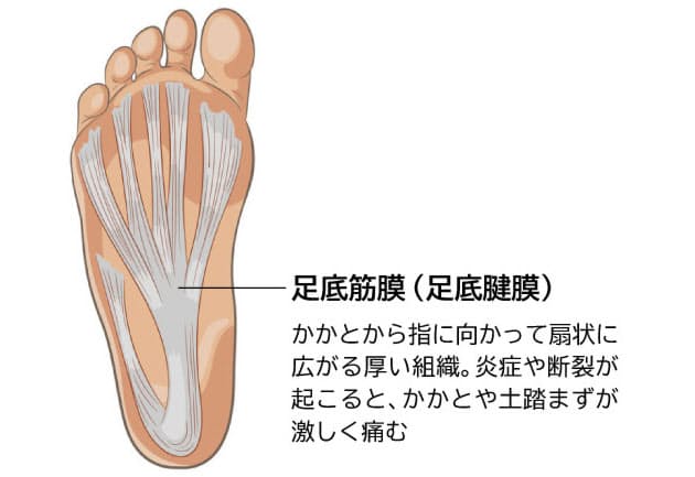 答えと解説 足裏に激痛が走る 足底筋膜炎 なりやすい人って Nikkei Style 答えと解説 足裏に激痛が走る 足底筋膜炎 なりやすい人って Nikkei Style