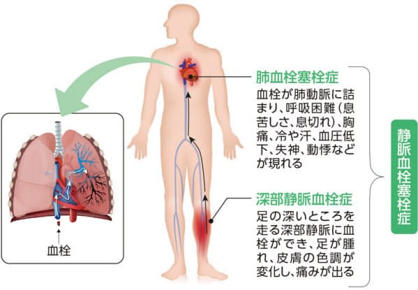 足の血栓 肺に詰まって死に至ることも 飛行機搭乗より多いのは Nikkei Style Goo ニュース 足の血栓 肺に詰まって死に至ることも 飛行機搭乗より多いのは Nikkei Style Goo ニュース