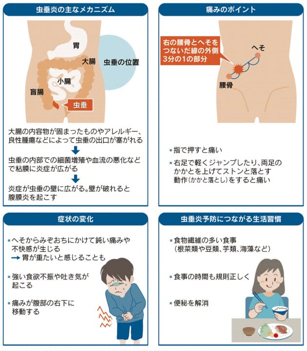 実は夏に多い虫垂炎 右下腹に痛み 再発リスク意識 Nikkei Style
