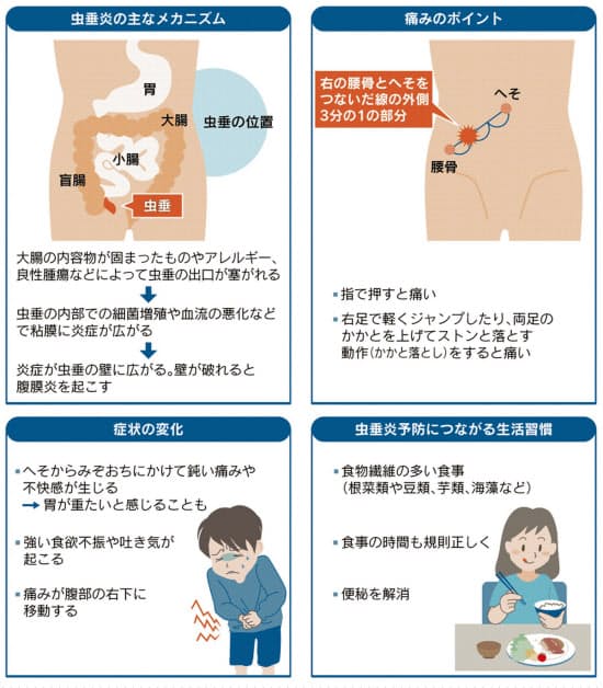 実は夏に多い 虫垂炎 右下腹に痛み 再発リスク意識して Nikkei Style Goo ニュース 実は夏に多い 虫垂炎 右下腹に痛み 再発リスク意識して Nikkei Style Goo ニュース