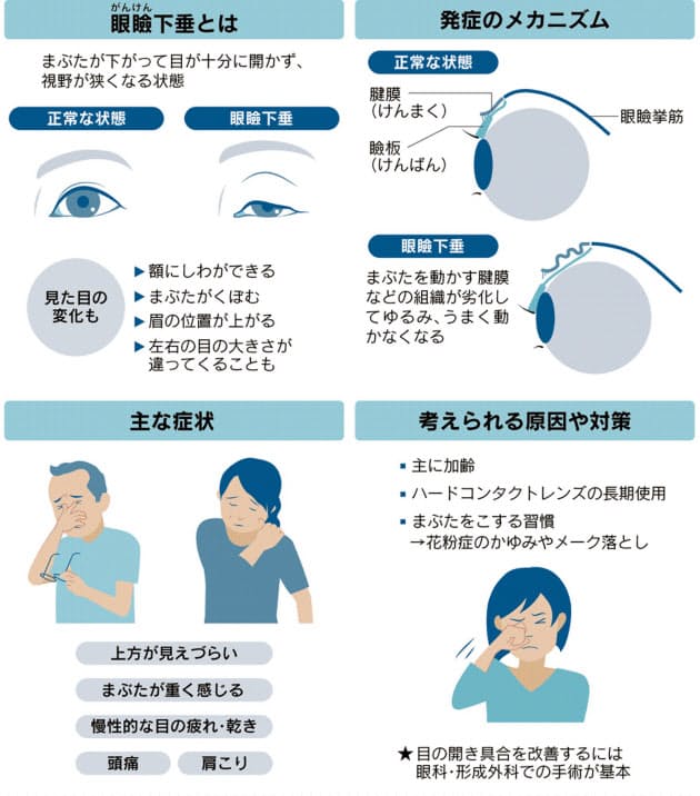 原因は加齢だけでない 眼瞼下垂 目のこすりすぎ注意 Nikkei Style 原因は加齢だけでない 眼瞼下垂 目のこすりすぎ注意 Nikkei Style