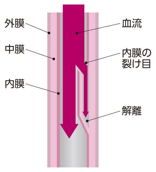 突然死につながる 急性大動脈解離 予兆なく発症 血圧高めの人は注意 Nikkei Style Goo ニュース